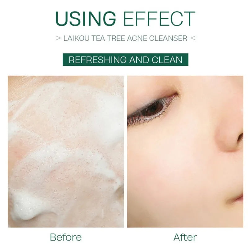 Tea Tree Acne Cleanser Facial Cleansing Wash